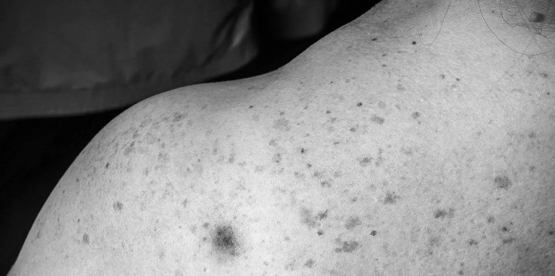 The Science of Skin Cancer – Recognition, Risk, and Prevention